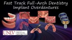Full-Arch Dentistry - Implant Overdentures