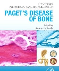 Advances in Pathobiology and Management of Paget’s Disease of Bone