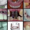 A-Z in Restorative Implant Dentistry Series (16 Lectures)