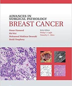 Advances in Surgical Pathology Breast Cancer 1st Edition