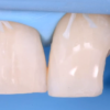 Gidedental Direct and Indirect Adhesive Restorations – Minimal Invasive Treatment of the Anterior and Posterior Damaged Dentition using Direct Bonded Restorations 2020 (CME VIDEOS)