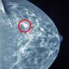 UCSF Breast Imaging 2022 (CME VIDEOS)