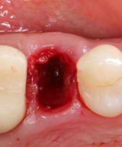 Extraction Socket – Preservation/Grafting; Immediate vs Delayed Implants; Pontic Site Development