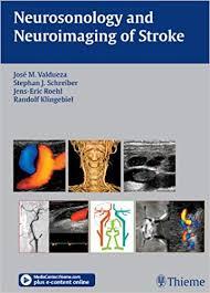 Neurosonology and Neuroimaging of Stroke