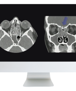 ARRS Cranial Nerve Imaging: From the Least to the Last 2022 ( Videos + CME Questions)