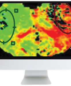 Code Stroke: What the Radiologist Needs to Know in the Changing Landscape of Acute Ischemic Stroke 2019 (CME VIDEOS)