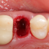 Gidedental Extraction Socket – Preservation/Grafting; Immediate vs Delayed Implants; Pontic Site Development 2020 (CME VIDEOS)