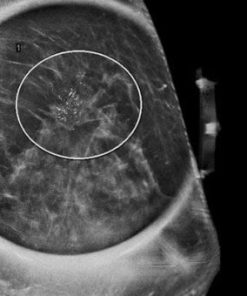 MRIOnline Imaging Mastery Series: High Risk Screening Breast MRI 2021 (CME VIDEOS)