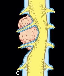 MRIOnline MRI Mastery Series: Extradural Lesions 2020 (CME VIDEOS)