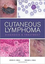 Cutaneous Lymphoma: Diagnosis and Treatment 1st Edition