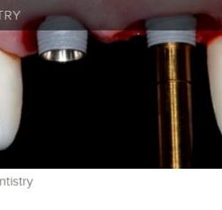 gIDE A to Z in Implant Dentistry (Course)