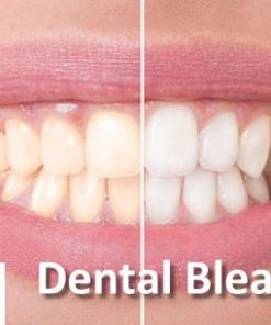 DentalXP Dental Bleaching (Course)