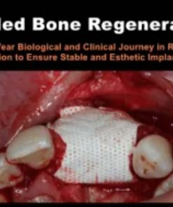 Guided Bone Regeneration: A 30 year Biological and Clinical Journey in Ridge Augmentation (Course)