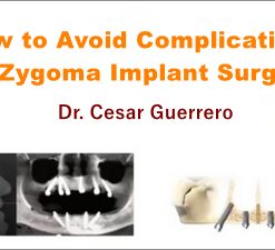 How to Avoid Complications in Zygoma Implant Surgery (Course)