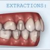 Invisalign and Extractions
