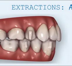 Invisalign and Extractions (Course)