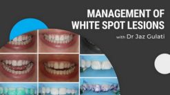Management of White Spot Lesions