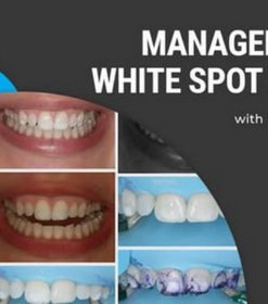 Management of White Spot Lesions (Course)