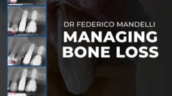 Managing Bone Loss