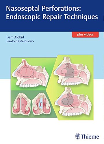 Nasoseptal Perforations: Endoscopic Repair Techniques (PDF Book)