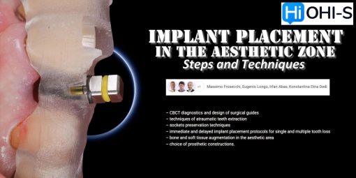 Implant Placement in the Aesthetic Zone