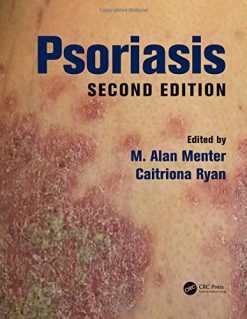 Psoriasis, Second Edition (EPUB)