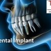 The Dental Vortex – Dental Implant (Course)