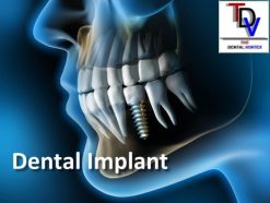 The Dental Vortex – Dental Implant (Course)