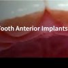 Classic Collection: Single Tooth Anterior Implants