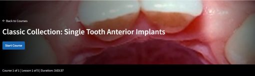 Classic Collection: Single Tooth Anterior Implants