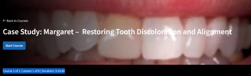 Case Study: Margaret –  Restoring Tooth Discoloration and Alignment