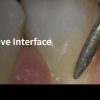 The Periodontal-Restorative Interface