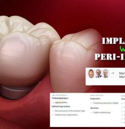 OHI-S Implantation Without Peri-Implantitis (Course)