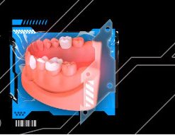 OHI-S Veneers, inlay, onlay, crowns: full protocols