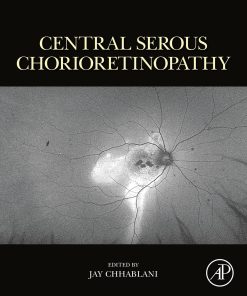 Central Serous Chorioretinopathy (EPUB)