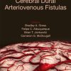 Cerebral Dural Arteriovenous Fistulas (EPUB)