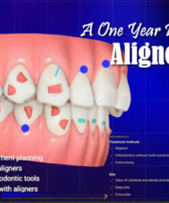 Anterior Implant Esthetic Restorations