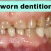 Spear : Treating worn dentition 2021