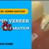 Bicuspid Veneer & V-Onlay Preparation – Dennis Hartlieb