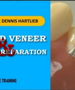 Bicuspid Veneer & V-Onlay Preparation – Dennis Hartlieb