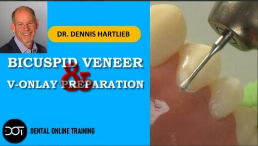 Bicuspid Veneer & V-Onlay Preparation – Dennis Hartlieb