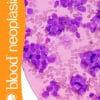 Blood Neoplasia PDF