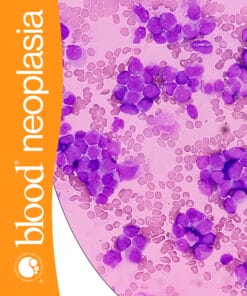 Blood Neoplasia PDF