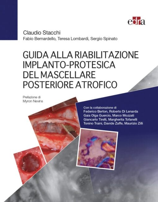 Guida alla riabilitazione implantoprotesica del mascellare posteriore atrofico  pdf