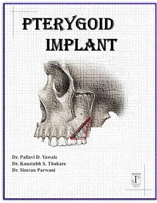 PTERYGOID IMPLANT PDF