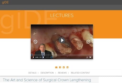 gIDE ondemand lectures – The Art and Science of Surgical Crown Lengthening  